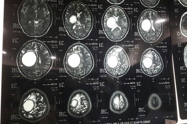 Intracranial Hydatid Cyst