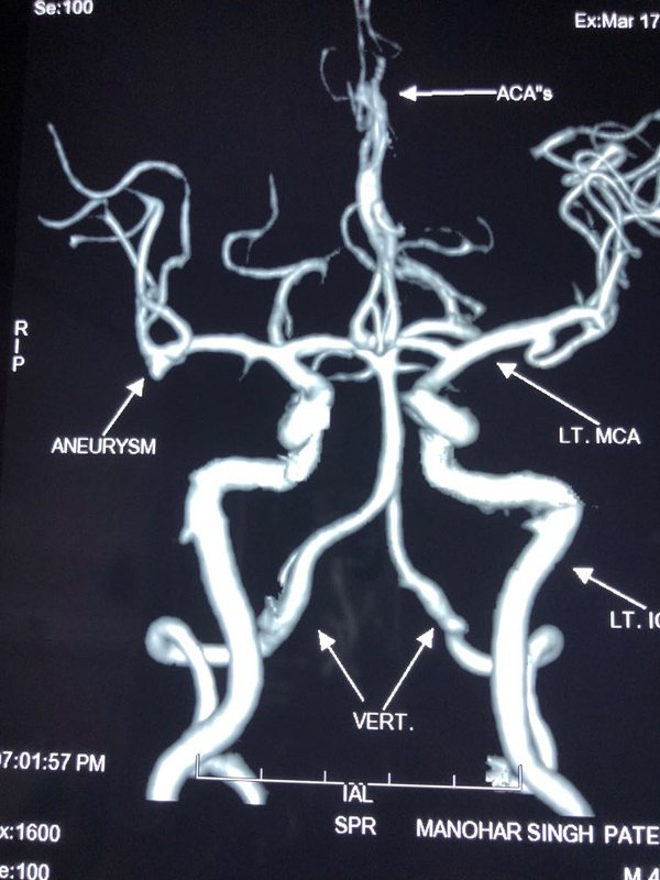 MCA Aneurysm