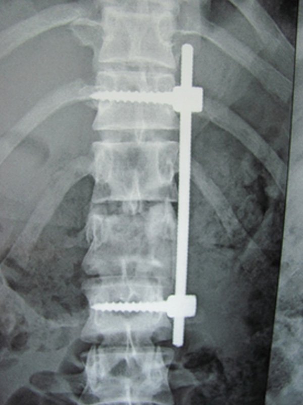 SPINE TRAUMA-ANT-LAT FUSION