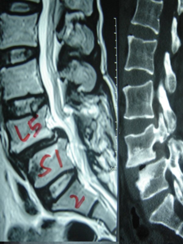 SPONDYLOLISTHESIS FIXATION