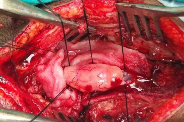 Spine Tumour