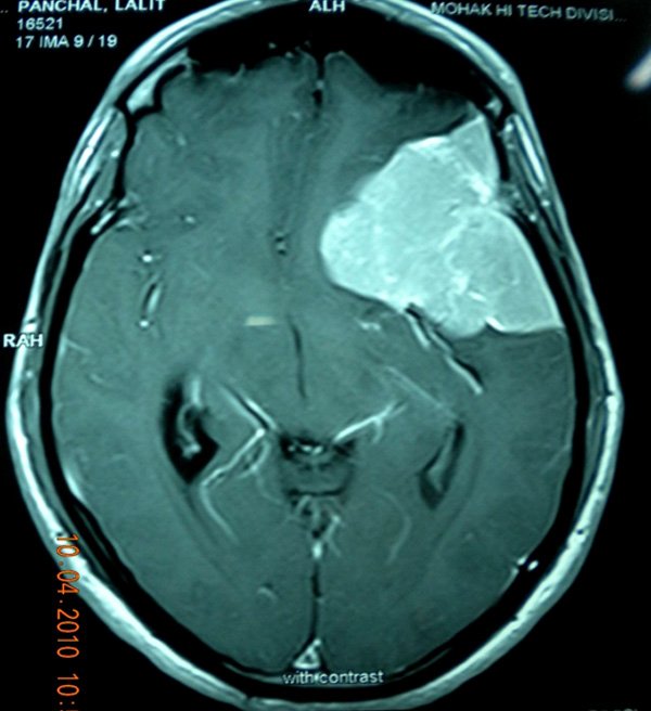 LEFT SPHENOID WING MENINGIOMA