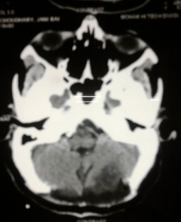 POSTERIOR FOSSA MENINGIOMA