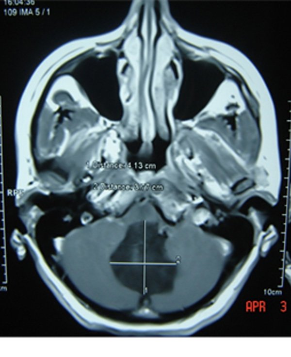 POSTERIOR FOSSA EPIDERMOID