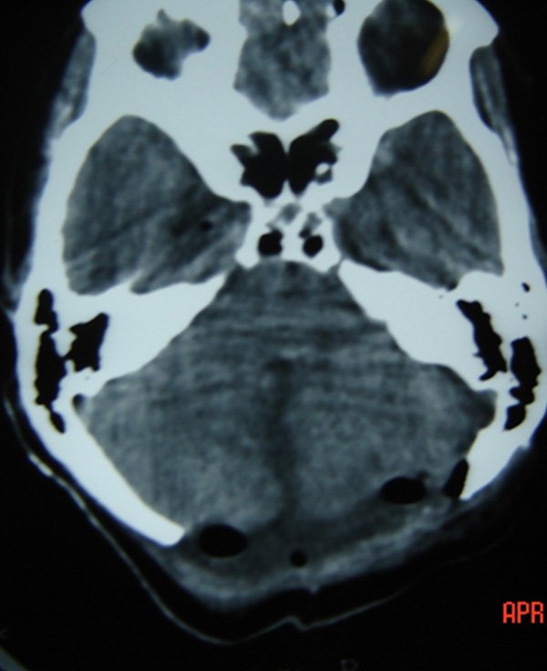 POSTERIOR FOSSA EPIDERMOID