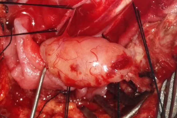 Spine Tumour