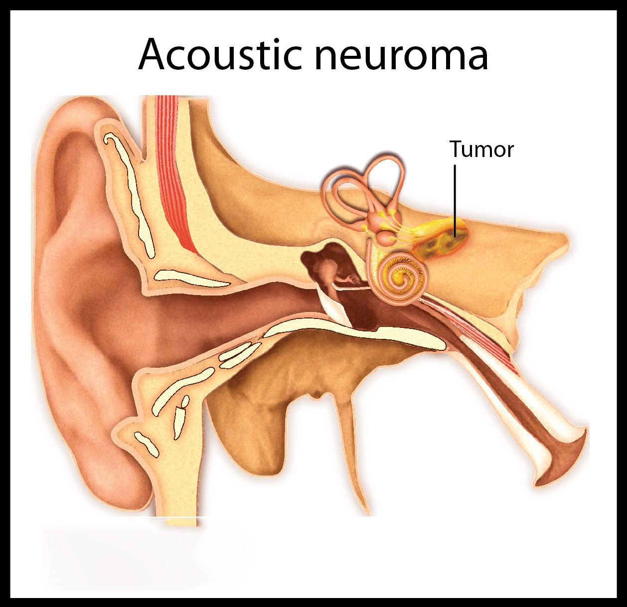 acoustic-neuroma